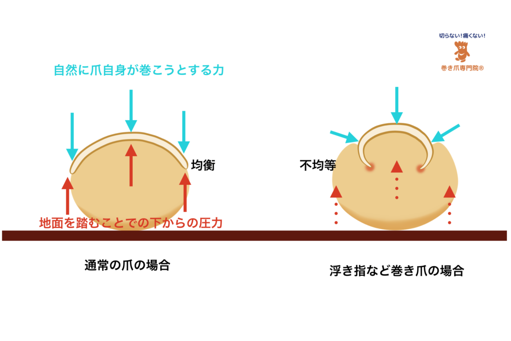新宿・西新宿の東京巻き爪矯正院　新宿院　浮き指問題の爪の圧力バランス